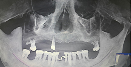 Full-teeth dental implant technique on dental Implant: All-on-4
